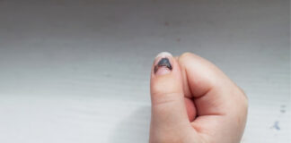 Nail Melanoma: The Subtle Signs Under Your Nail You Shouldn’t Ignore Nail Melanoma The Subtle Signs Under Your Nail