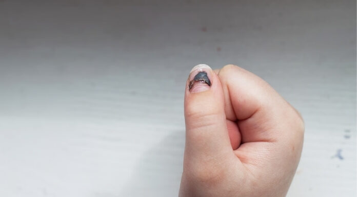 Nail Melanoma: The Subtle Signs Under Your Nail You Shouldn’t Ignore Nail Melanoma The Subtle Signs Under Your Nail