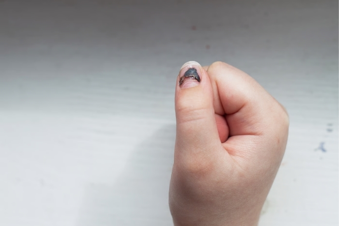 Nail Melanoma The Subtle Signs Under Your Nail Nail Melanoma The Subtle Signs Under Your Nail