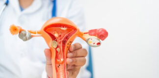 Should You Treat Polycystic Ovaries Without Symptoms? What Gynecologists Say Should You Treat Polycystic Ovaries Without Symptoms