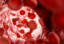 Sickle Cell Disease: Symptoms, Causes, and Treatment Explained Sickle Cell Disease