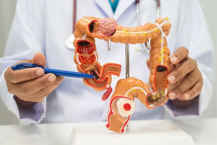 What Doctors Want Patients to Understand About Diet and Colon Cancer