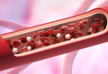 What Happens to Your Arteries When Cholesterol Is High — Explained Step by Step What Happens to Your Arteries When Cholesterol Is High Explained Step by Step