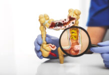 What Is Early-Onset Colorectal Cancer and Who Is Most at Risk? What Is Early-Onset Colorectal Cancer and Who Is Most at Risk
