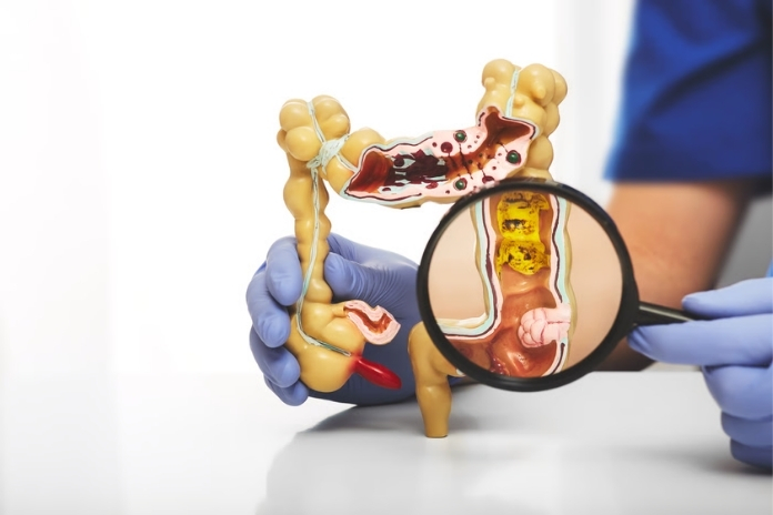 What Is Early-Onset Colorectal Cancer and Who Is Most at Risk What Is Early-Onset Colorectal Cancer and Who Is Most at Risk