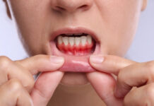 What Is Periodontitis? Causes, Symptoms, and What Treatment Actually Involves What Is Periodontitis
