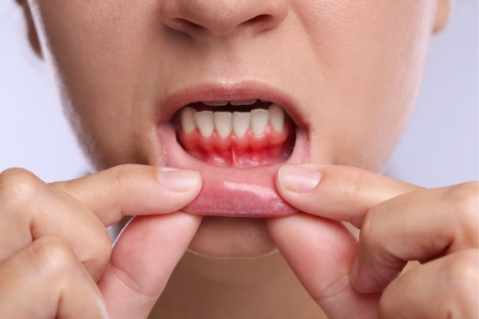 What Is Periodontitis What Is Periodontitis