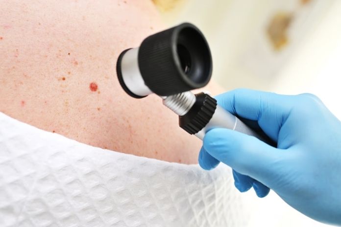 Why Nail Melanoma Is Different From Typical Skin Melanoma