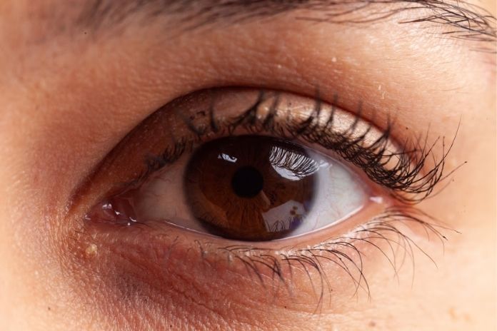 Xanthelasma and Xanthomas Yellowish Deposits Near Eyes