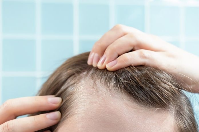 Can PCOS Hair Loss Grow Back