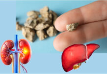 Gallstones vs Kidney Stones: Key Differences in Symptoms, Causes, and Treatment Gallstones vs Kidney Stones Key Differences
