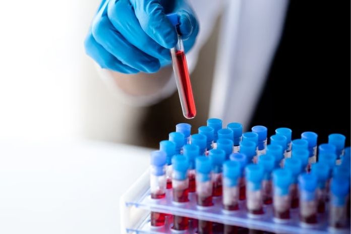 How PCOS Hair Loss Is Diagnosed