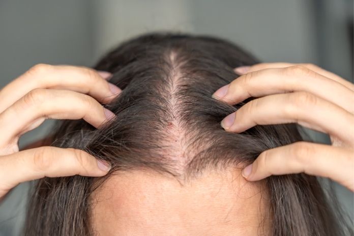 Signs and Symptoms of PCOS Hair Loss