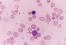 First Cyclosporiasis Deaths Reported as U.S. Outbreak Surpasses 18,000 Cases First Cyclosporiasis Deaths Reported as US Outbreak Surpasses 18000 Cases