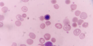 First Cyclosporiasis Deaths Reported as U.S. Outbreak Surpasses 18,000 Cases First Cyclosporiasis Deaths Reported as US Outbreak Surpasses 18000 Cases